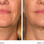 ULTHERAPY by Merz Aesthetics